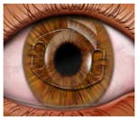 IOL Intraocular Lens Implant Treatment, Intraocular Lens Treatment India, Intraocular Lens